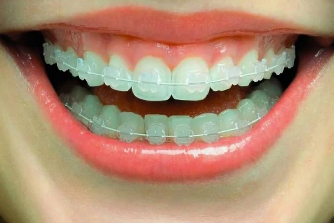 ORTODONTIA – Clínica Odontológica Botafogo